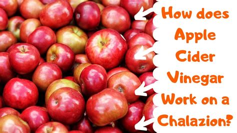 apple cider for chalazion